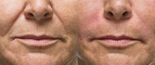 Radiesse před a po zákroku