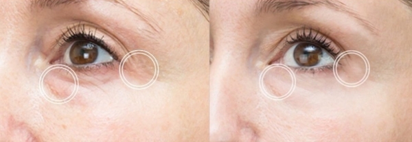 Rejuran - Před a po zákroku