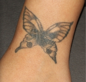 Tattoo removal