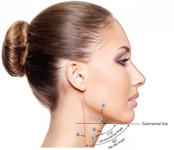 V-lifting – lifting spodní části obličeje