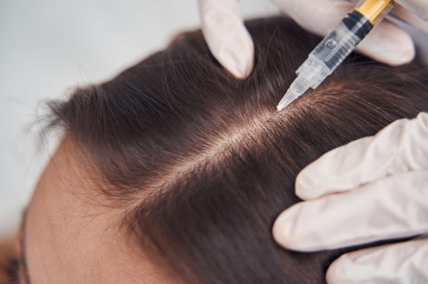 Vlasová mezoterapie řídnoucí vlasové pěšinky