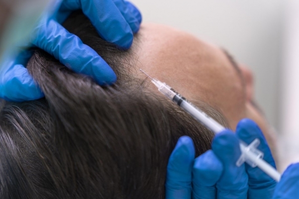Vlasová mezoterapie ztráty vlasů koutů, nejčastější typ mužské alopecie
