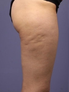 Z Shape PŘED zákrokem