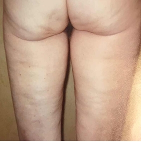 Z Shape – terapie celulitidy