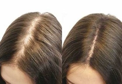 Zarůstání vlasové pěšinky po sérii mezoterapií