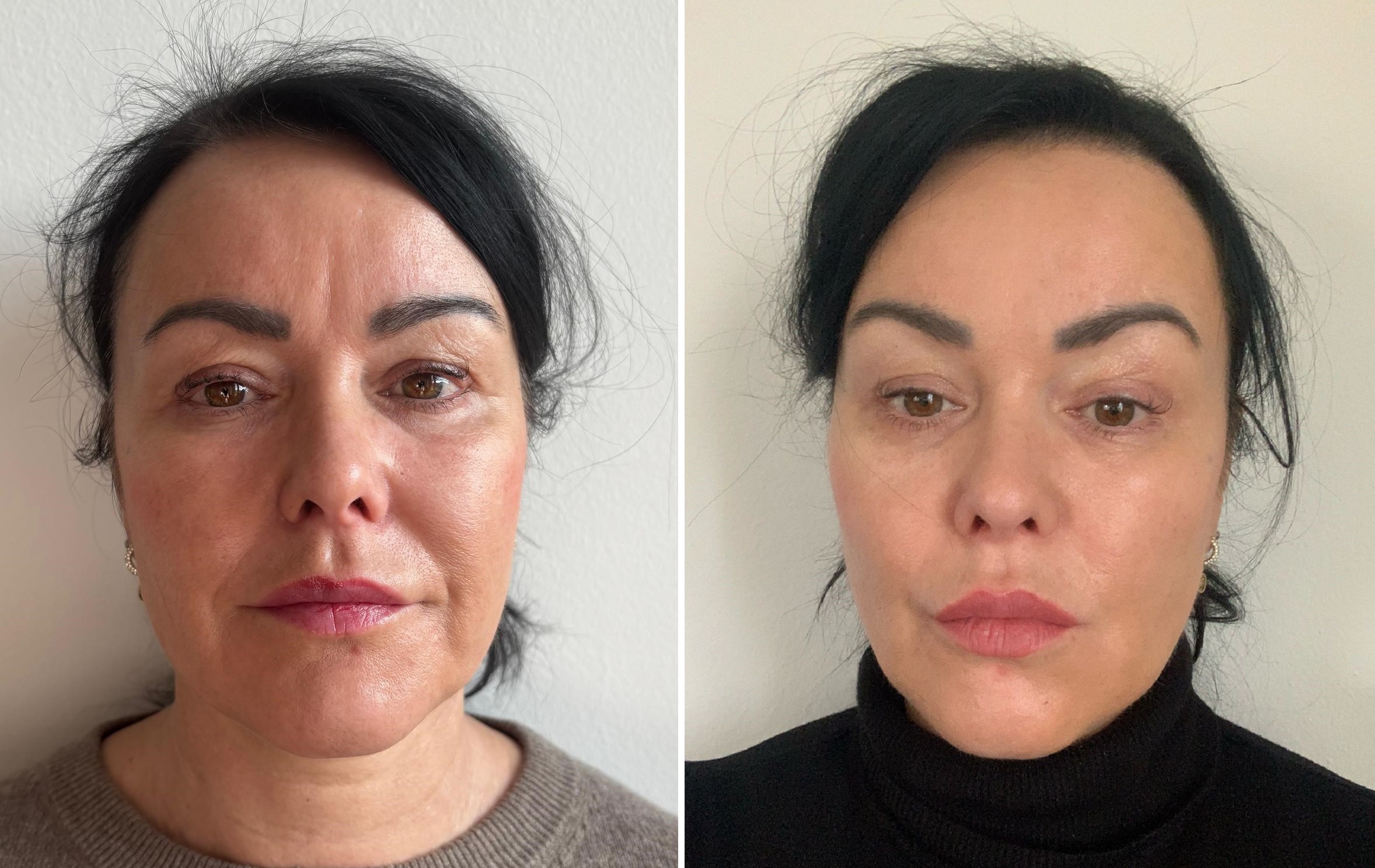 Zákrok: Endolift – laserový lifting k vypnutí pokožky - PŘED a PO