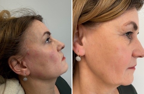 Zákrok: Konturace čelisti