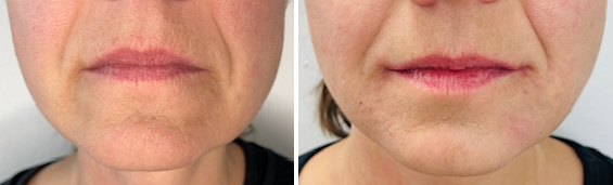 Zákrok: Marionetové rýhy - PŘED a PO