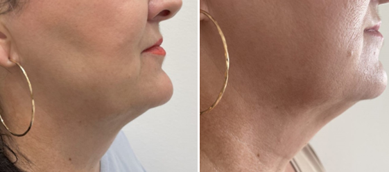 Zákrok: Moderní řešení podbradku Endoliftem X®