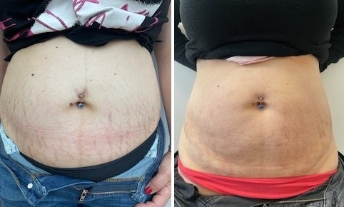 Zákrok: Ošetření strií mikrojehličkovou radiofrekvencí