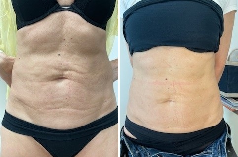 Zákrok: Vypnutí a vyhlazení pokožky břicha Endoliftem